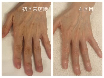 キレイテ 福岡天神店/50代/4回目【天神ハンドケア】