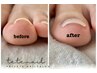 ［全員］【foot/ペディバランス】～１度の施術で巻爪矯正を実感！！～