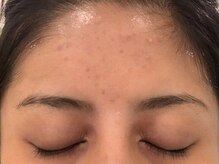 アクネビューティー 恵比寿代官山(ACNE BEAUTY)/ニキビケアbefore[恵比寿/毛穴]