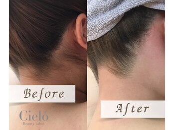 シエロ 町田店(Cielo)/『うなじ脱毛』