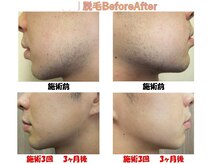ピービー(PB)/脱毛