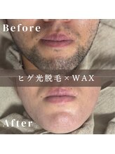 エピナ 横浜店(Epina)/メンズひげ脱毛/ヒゲ脱毛/髭脱毛