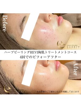 エスプリ 銀座店/ハーブピーリングREVI陶肌銀座