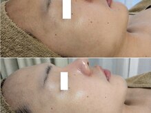 アン(anne)/毛穴洗浄＆ハーブピーリング２回