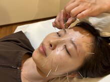 鍼灸ハウス(鍼灸house)/抗酸化美容鍼灸