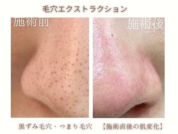 ミリ(MiLi)/黒ずみ・つまり毛穴