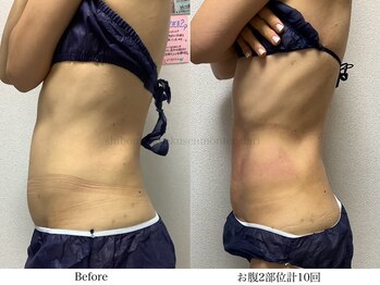 スラリ(SLARI)/【腹部　脂肪冷却】期間4か月