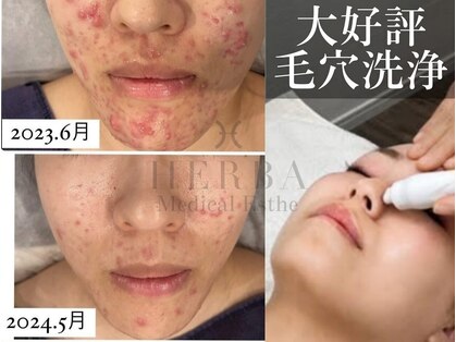 ヘルバ(HERBA)の写真