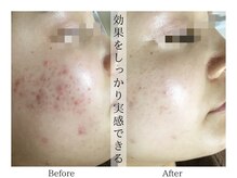 リララ(lelala)/ビフォーアフター☆