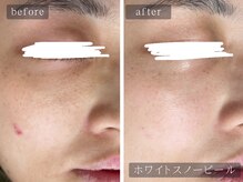 アムールサロン(Amour salon)/ホワイトスノーピール【新宿】