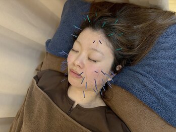 こじま 富雄団地接骨院/ヒト幹細胞美容鍼