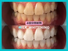 ミルクホワイトニング 久留米店(Milkホワイトニング)/施術例