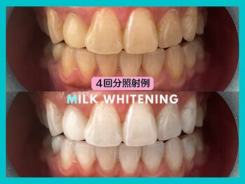 ミルクホワイトニング 久留米店(Milkホワイトニング)/施術例