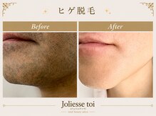 ジョリエストワ(Joliesse toi)の雰囲気（ヒゲ脱毛Before→After清潔感もアップし、若々しい見た目に！！）