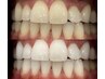 豊橋初医療提携【平均4トーンUP】本気で歯を白くしたい方に!13分×3回照射