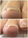 巻き爪矯正（アクリル使用）