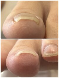 巻き爪矯正（アクリル使用）