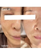 ルココン エミュ(le cocon e'mue)/ExoLift