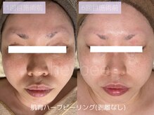 ハービー(Herbee)/剥離なしでもここまで変わる