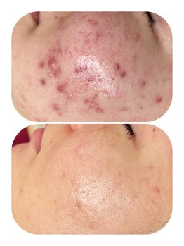 ミロク(MIROKU.)/陶肌トリートメント