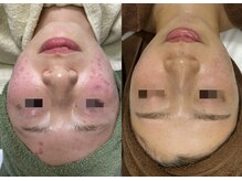 肌質改善専門【Salon da Mahina】毛穴ケア/ニキビケア/ハーブピーリング/ニキビ/ハーブピーリング/藤沢