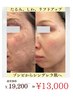【しわ・たるみ改善】ゾンビのようなお顔からシンデレラに¥17,000→¥11,000