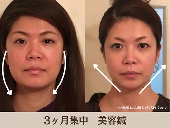 ピュアハリの写真/写真で気づく老け見え顔に。たるみ・ほうれい線美容鍼