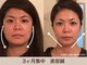 ピュアハリの写真/写真で気づく老け見え顔に。たるみ・ほうれい線美容鍼