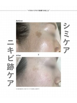 ミレラ(Mirela)/シミ色ムラを根本ケア!透明感UP