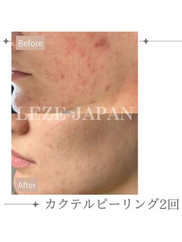 フロート(float)/カクテルピーリング2回目