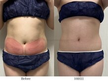 スラリ(SLARI)/【腹部　脂肪冷却】期間4か月