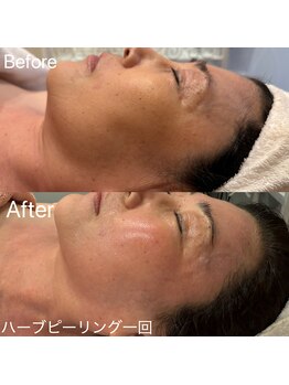 スカーレット 北参道(Scarlett)/【50代の方 ハーブピーリング】