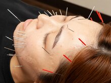 ふなと川接骨院 倉賀野院/美容鍼【群馬　高崎　美容鍼灸】