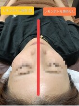 縁(en)/レモンボトル1回施術☆