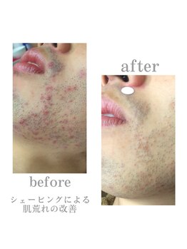 アデージョ アデオス(Ade-jyo.Adeosu)/【ヒゲ脱毛】カミソリ負け肌荒れ