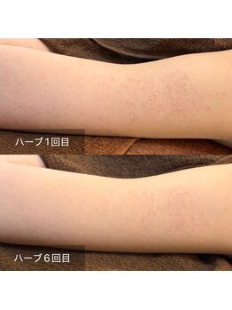 ビビ(VIVI)/二の腕ケアに