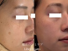 エステティック リベル キョウト 京都駅前店(Esthetic Liber Kyoto)/魔法のシミケア