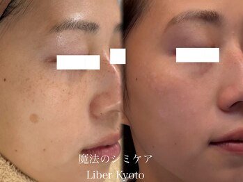 エステティック リベル キョウト 京都駅前店(Esthetic Liber Kyoto)/魔法のシミケア