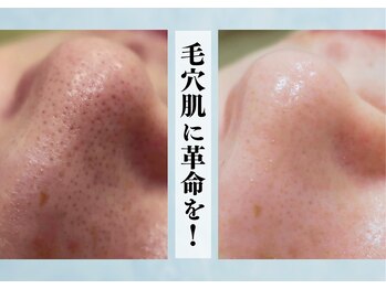 リヴェーヌ 富山店の写真/【大切なのは】毛穴洗浄！…だけでなく、毛穴が開く原因にアプローチ◎【リバウンドしないこと！】