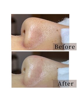 癒える(ielu)/毛穴エクストラクションB/A★