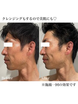 クリア(CLEAR)/小顔美整顔