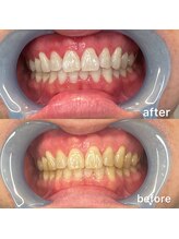 フレスコ レディース 刈谷店(FRESCO)/ホワイトニング