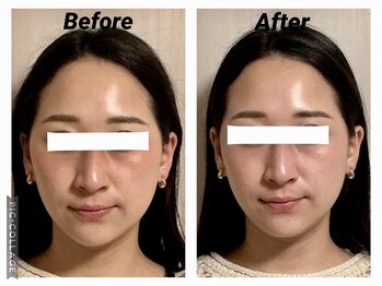 ショウフェイスデザイン(Sho Face Design)/《小顔矯正》ビフォーアフター