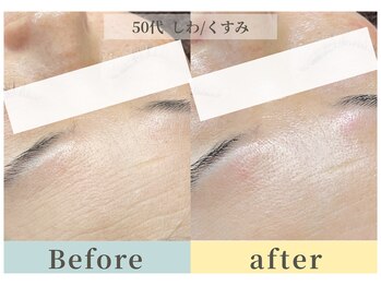 ムク(Muqu.)/face脱毛でハリまで生まれる。