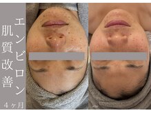 【本気の肌管理】繰り返すトラブル専門 ニキビ/毛穴/たるみ/シミ
