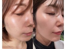 フェイスプラスリフ(FACE+RiF)