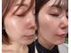 フェイスプラスリフ(FACE+RiF)の写真