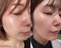 フェイスプラスリフ(FACE+RiF)