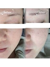 ソア(Soa)/ララピール×毛穴洗浄