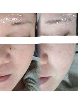 ソア(Soa)/ララピール×毛穴洗浄